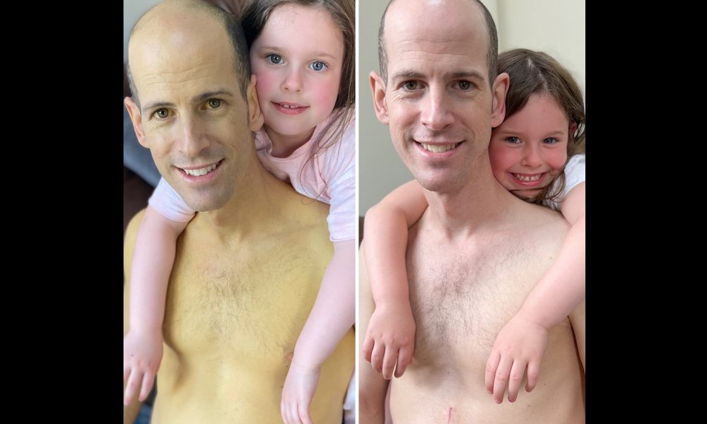 Dad Who Had Liver Transplant Shares Eyeopening Before And After Photos